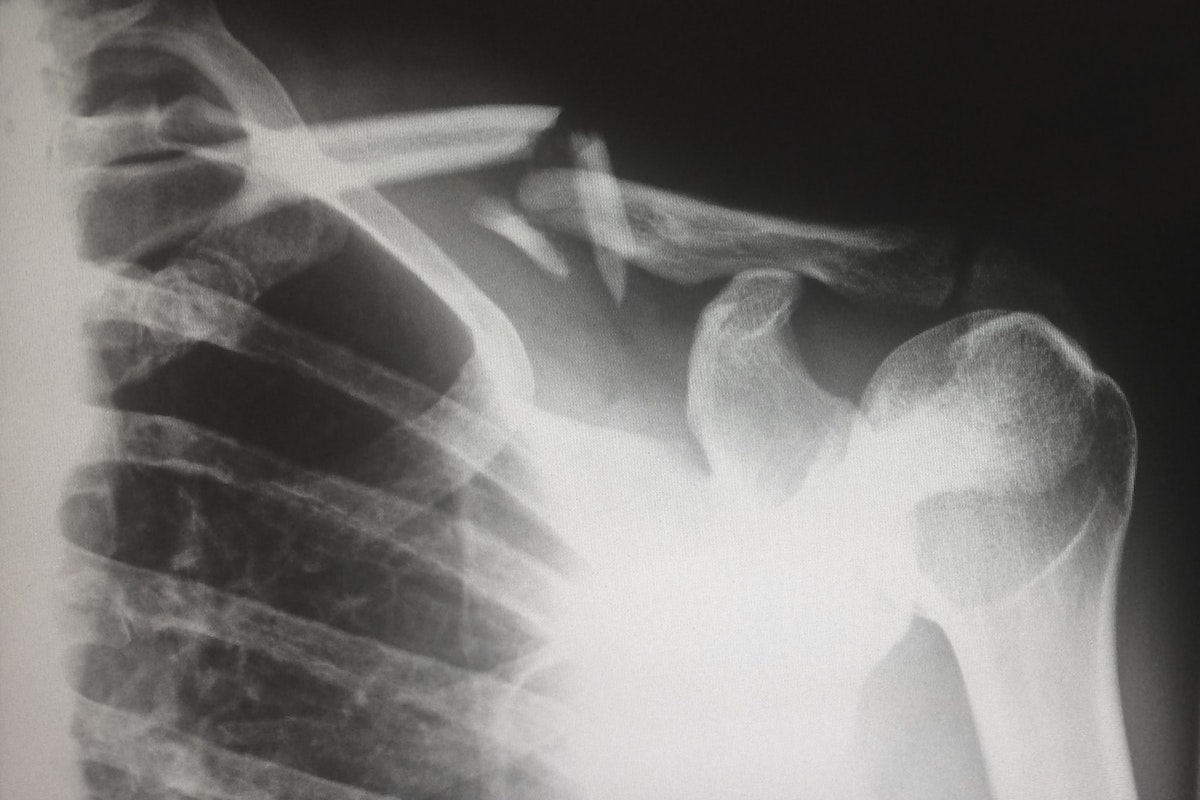 Xray showing broken clavicle.